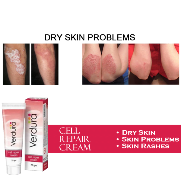 dry skin & psoriasis, psoriasis treatment, dry skin treatment, cell repair cream for psoriasis