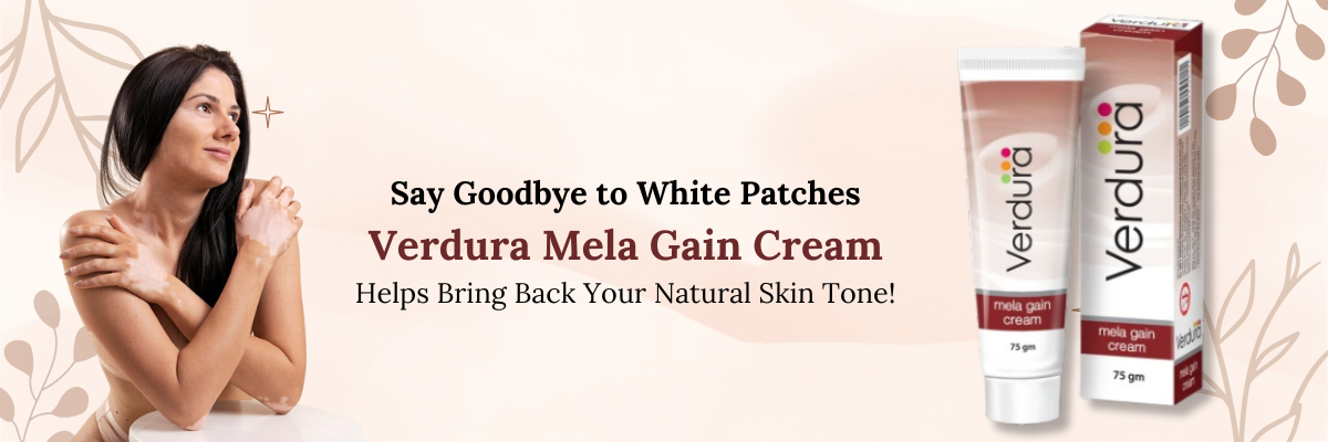 vitiligo treatment